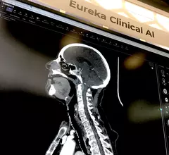 Brain imaging artificial intelligence is a primary area of concentration for AI because oif the critical nature of fast detection and treatment for patients. This is an example of the AI applications displayed by third-party advanced visualization vendor TeraRecon at RSNA 2022.