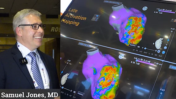 Sam Jones, MD, explains why CMS reduced payments for EP ablation and how it will negatively impact electrophysiology. #HRS #HRS2023 #EPeeps #EPlab #Medicare