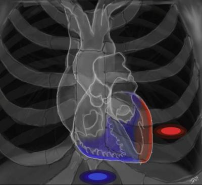 Hybrid EP ablation - 16.89 Kb