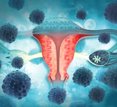 ovaries ovarian cancer