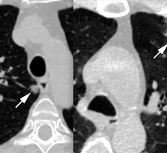 Examples of two lung cancers that were caught using low dose CT lung screening. Image from RSNA