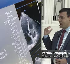 Video of Partho Sengupta, MD, explaining two major shifts in AI for echocardiography at ASE 2023. These include GPT and deep learning to automate measurements. #ASE23 #ASE2023 #ASE #AI 