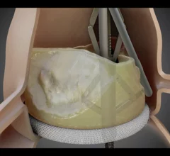 Pi-Cardia ShortCut TAVR device