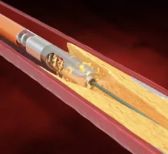 The U.S. Food and Drug Administration (FDA) has shared a new warning about ongoing safety issues with atherectomy devices sold and distributed by Bard Peripheral Vascular, an Arizona-based subsidiary of Becton, Dickinson and Company (BD). The warning includes multiple models of Bard Peripheral Vascular’s Rotarex Atherectomy System, which is designed to target high-risk plaques and blood clots in the peripheral arteries by rotating at a high speed. 