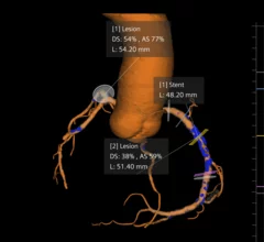 Siemens Healthineers software Syngo.CT Coronary Cockpit