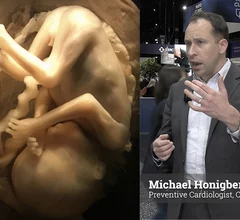 Michael Honigberg, MD, MPP, a preventive cardiologist and cardiovascular researcher at Massachusetts General Hospital, explains how preeclampsia and gestational hypertension during pregnancy can elevate cardiovascular risks later in life and how to best manage these patients.