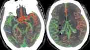 Ischemic stroke CT scan showing color coded blood flow for early and later arterial and venous contrast phases and areas of blocked blood flow. Image courtesy of RSNA