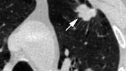 An example of a lung cancer found using low-dose computed tomography (LDCT). Image courtesy of RSNA
