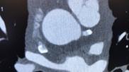 Cardiac CT imaging has been moved to the forefront of medical imaging to evaluate chest pain under the new 2021 chest pain guidelines from the AHA and ACC. #Yescct #CCTA #CTA #CT