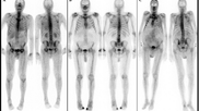 cardiac amyloidosis on bone scan. Image courtesy of the Department of Nuclear Medicine, Medical University of Vienna, Austria.