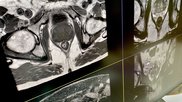 Prostate MRI GE RSNA23 DF 2