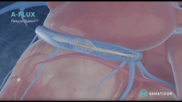 Image of the A-FLUX Reducer System for chest pain by VahatiCor.