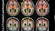 light therapy improves brain connectivity after head trauma
