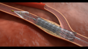 Contego Medical, a North Carolina-based medical device company, has received U.S. Food and Drug Administration (FDA) approval for its new all-in-one carotid stenting offering, the Neuroguard IEP System.