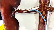 The Recor Medical renal denervation (RDN) system, pictured here at TCT 2024, and Medtronic’s Symplicity Spyral RDN system have received transitional pass-through payments from CMS for 2025.