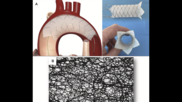 EnCompass F2 device from Nevada-based EnCompass Technologies. (A) Aortic arch deflector composed of a cylindrical nitinol frame that covers all three vessels supplying blood flow to the brain while allowing passage of the transcatheter aortic valve replacement system through its center. (B) It features an electrospun filter with very small pore size (30 μm average). Images/caption courtesy of JACC: Case Reports and George et al. 