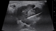 New ultrasound needle yielded more substantial tissue samples