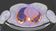 SPECT agent differentiates between active inflammation and fibrosis in lung disease