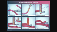 Distal anastomoses are almost exclusively hand-sewn as a current standard of care, which limits the widespread implementation of less-invasive approaches. This trial looked at the ability of the ELANA device to more easily construct distal anastomoses in CABG.