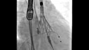 The NCPI-plus TAVR technique