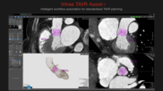 Canon Medical Informatics TAVR Assist+