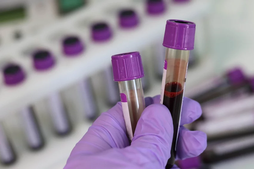 Blood Test Lab. A multidisciplinary panel recently published recommendations in the Journal of Pediatrics to promote early identification of children living with familial hypercholesterolemia (FH) through blood testing to better detect and prevent early onset cardiovascular disease.