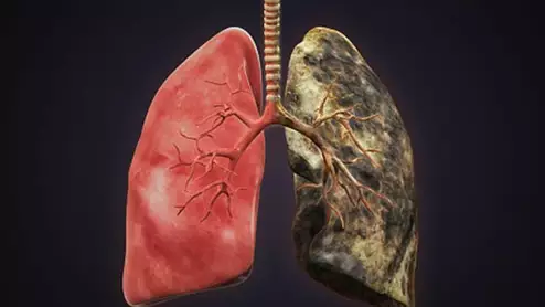 bad-lungs_759_getty.jpg