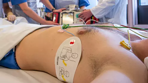 A large proportion of patients with atrial fibrillation (AF) end up in emergency rooms (ERs), but there are inherent issues with most hospital ERs handing off these patients to electrophysiologists for followup care. The ER2EP Study presented at the 2022 HRS meeting found better results of there is an organized pathway for AF patients to follow. #AFib