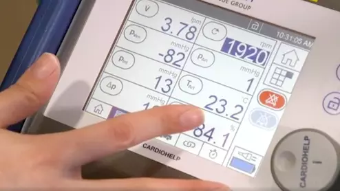 Extracorporeal membrane oxygenation (ECMO) can help patients with severe COVID-19 make a successful recovery. Venovenous ECMO (VV-ECMO) has the potential to minimize lung damage compared to conventional mechanical ventilation. ECMO unit in service with the COVID care unit at Banner Medical Center in Phoenix.
