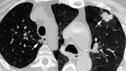 Examples of two lung cancers that were caught using low dose CT lung screening. Image from RSNA