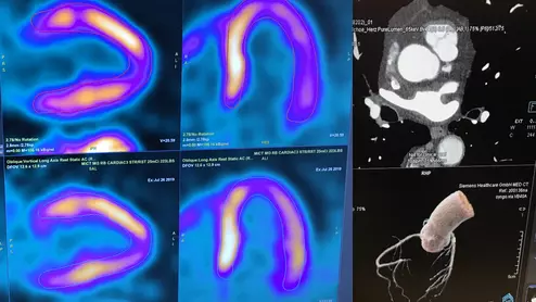The ASNC is one of several medical imaging societies asking Congress to repeal the appropriate use criteria (AUC) criteria mandate. They say it poses issues for clinicians and is becoming outdated by changes in CMS payment systems. The AUC requirements call for documentation using CVMS authorized software in order to show advanced imaging such as nuclear and CT is justified, or else Medicare payments might be withheld.