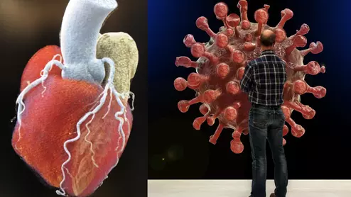 COVID-19 can have a serious impact effecting the heart during and after infection. The ACC released expert consensus decision pathway for the evaluation and management for the cardiovascular consequences of COVID infection and long-COVID, also known by its official clinical designation as post-acute sequelae of SARS-CoV-2 infection (PASC).