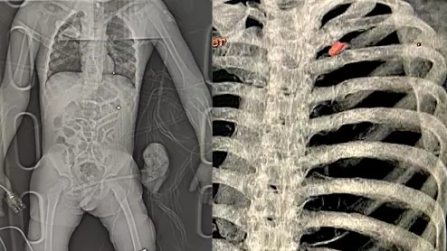 Radiology imaging of two wounded civilians with bullet and shrapnel embedded in tissue. Left is a digital X-ray of a patient with shrapnel in the chest and a bullet in the leg who was brought to the National Children's Specialized Hospital in Kyiv. Right, a 3D CT scan reconstruction of a bullet in the chest of a 40-year-old father who as attempting to evaculate his wife and child from the Russian advance near Kyiv when the Russians opened fire on him. Image from the Ukraine Heart Institute in Kyiv.