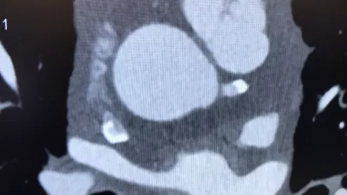 Cardiac CT imaging has been moved to the forefront of medical imaging to evaluate chest pain under the new 2021 chest pain guidelines from the AHA and ACC. #Yescct #CCTA #CTA #CT