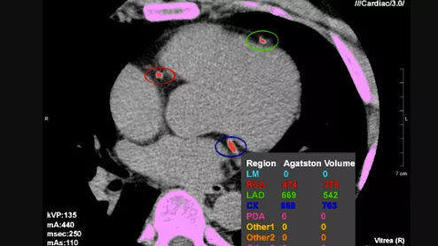 CT coronary artery calcium (CAC) scoring, also known as the Agatston score, to assess the risk a patient has for future heart attacks and help decide if a patient requires statins.