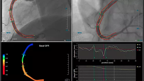 Example of QFR technology, which uses a rotation of the C-arm around the patient to create a 3D model and a color coded map showing the FFR values and drops in blood flow.