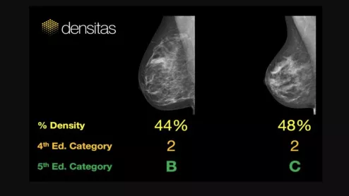 An example of commercially available artificial intelligence (AI) automated grading of breast density on mammograms from the vendor Densitas..