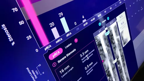 An example of an FDA cleared radiology AI algorithm to automatically take a cardiac CT scan and identify, contour and quantify soft plaque in the coronary arteries. The Cleerly software then generates an automated report with images, measurements and a risk assessment for the patient. This type of quantification is too time consuming and complex for human readers to bother with, but AI assisted reports like this may become a new normal over the next decade. Example from Cleerly Imaging at SCCT 2022.