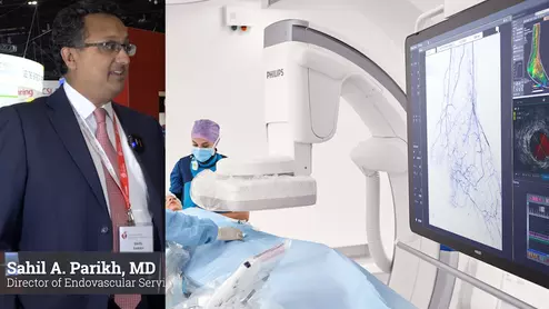 Sahil A. Parikh, MD, Director of Endovascular Services at Columbia University Irving Medical Center and Associate Professor of Medicine at the Columbia University College of Physicians and Surgeons, explained the growing trend or interventional cardiologists treating PAD and CLI. He shares what he thinks is important for cardiology departments to know before expanding expanding their programs in this space.