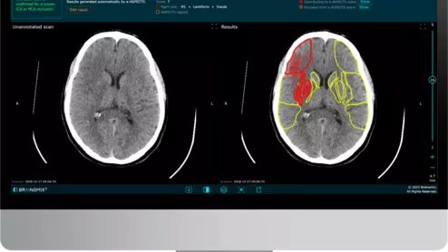 Brainomix stroke CT imaging
