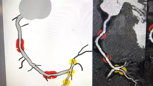 An example of HeartFlow's new RoadMap Stenosis software that uses artificial intelligence (AI) to show areas of interest for possible stenting based on a patient's CT scan and FFR-CT. This software is still undergoing beta testing at several hospitals and will likely be rolled out commercially later in 2023.