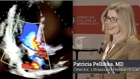 Echocardiography expert Patricia A. Pellikka, MD, discussed the trend of increasing artificial intelligence (AI) integration in cardiac ultrasound with Cardiovascular Business at American College of Cardiology (ACC) 2023 meeting.