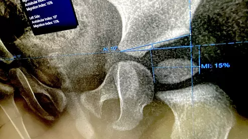 Automated AI measurements for Pediatric X-ray for hip dysplasia, Sectra HIMSS23.