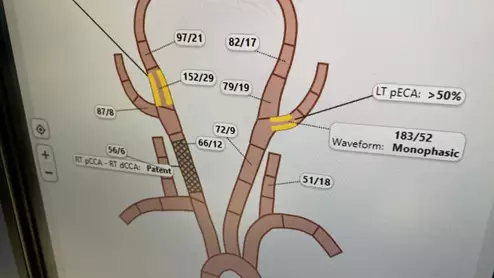 An interactive diagram for the carotids and arteries of the brain for interventional reporting shown by Fujifilm at HIMSS 2023. Photo by Dave Fornell