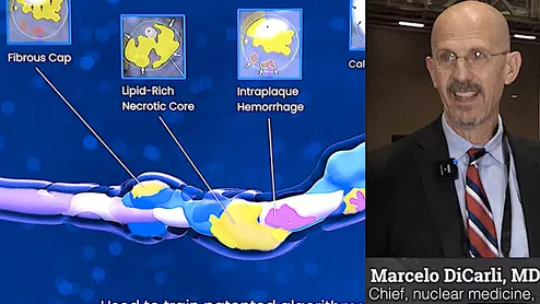 Marcelo DiCarli, MD, chief, division of nuclear medicine and molecular imaging, executive director for the cardiovascular imaging program, Brigham and Women's Hospital, discusses how artificial intelligence (AI) is impacting cardiac imaging.