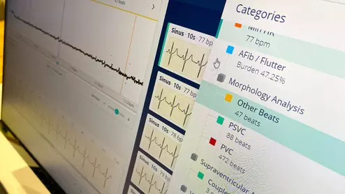 Artificial intelligence (AI) analysis from a remote ECG monitor showing the AI generated report on the Philips Cardiologs system, during a demonstration of the technology at Heart Rhythm 2023. Photo by Dave Fornell