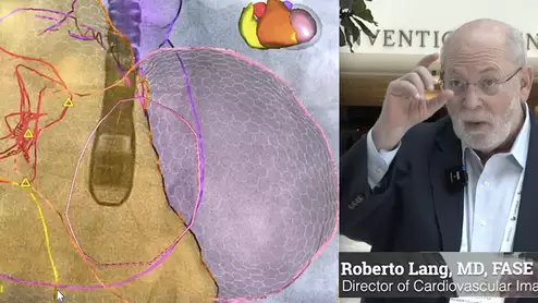 Roberto Lang, MD, explained the AI advances in echocardiography that will make it a requirement to have in the coming years at ASE 2023. #ASE #AIhealthcare #ASE2023