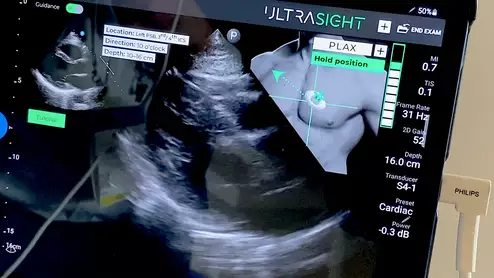 Ultrasight's AI to guide echo cardiac ultrasound POCUS exams at ASE 2023. The thumbnail of the chest shows the user how to the position the transducer and where to move or stop for image acquisition. The bar graph shows the quality of the image.