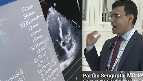 Video of Partho Sengupta, MD, explaining two major shifts in AI for echocardiography at ASE 2023. These include GPT and deep learning to automate measurements. #ASE23 #ASE2023 #ASE #AI