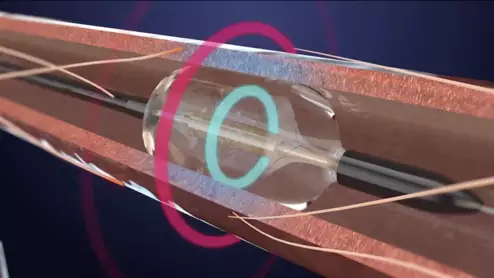 The U.S. Food and Drug Administration (FDA) has approved Recor Medical’s Paradise Ultrasound Renal Denervation (RDN) system for uncontrolled hypertension. The Recor system gained FDA clearance in November 2023.